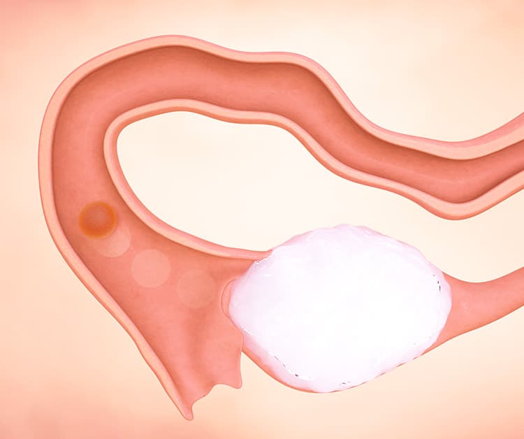 Egg travels down the fallopian tubes in hopes of being fertilized by the sperm